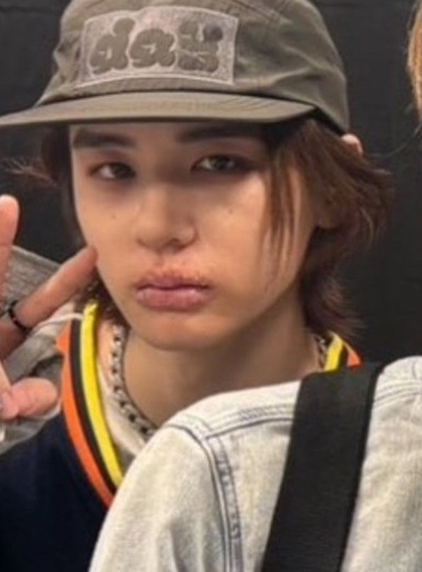 실수로 올라온 무보정 사진인데 진짜 아파보이는 아이돌 | 인스티즈