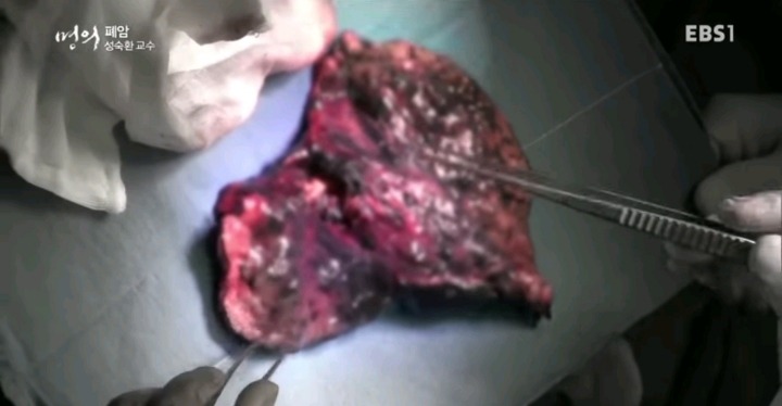 폐암 3기환자의 폐.jpg (사진주의) | 인스티즈