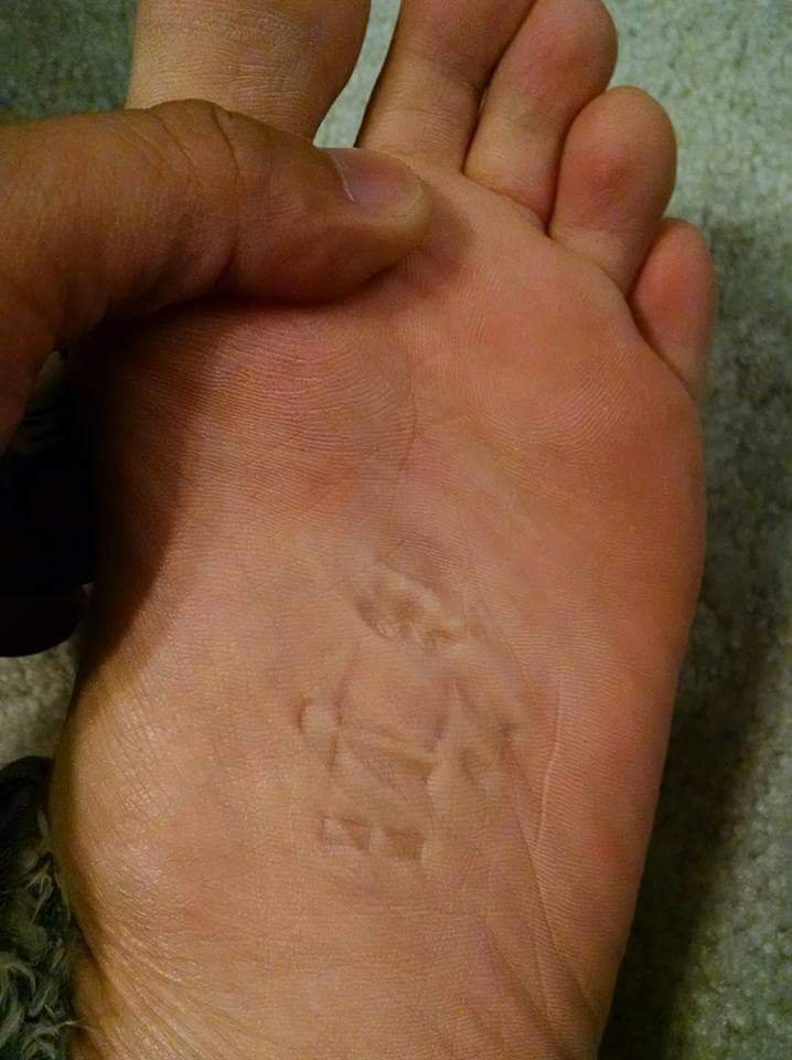 실수로 지뢰 밟은 발 상태 사진 | 인스티즈
