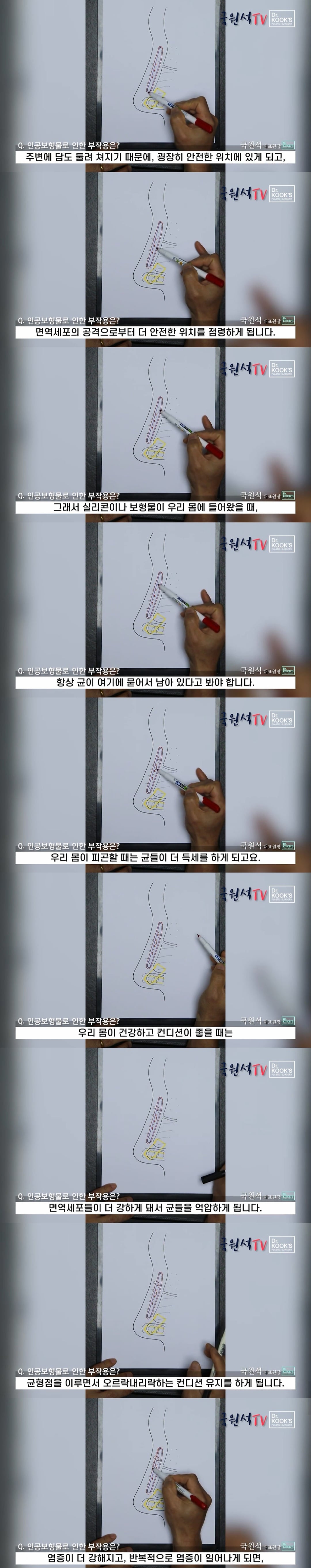 코 성형 후 구축이 생기는 과정 | 인스티즈