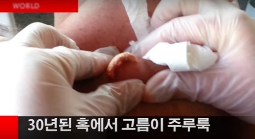 혐주의 등 30년된 고름짜기.gif | 인스티즈