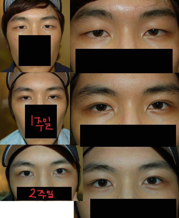 요즘 남자들이 많이 한다는 눈 성형 | 인스티즈