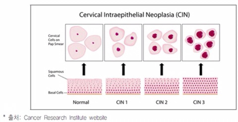 자궁경부암 hpv 병과 검사 Q&A (여자라면 꼭 읽어봐야함) | 인스티즈