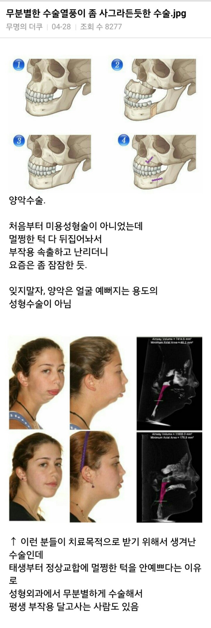 무분별한 수술열풍이 좀 사그라든듯한 성형수술 | 인스티즈