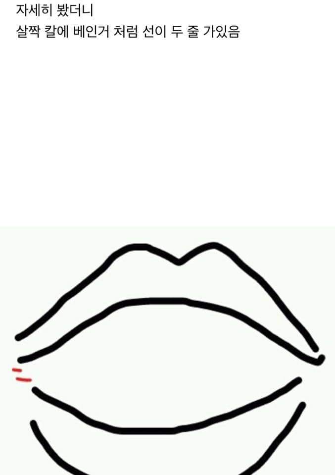 치과에서 사랑니뽑다가 입찢어질뻔한 썰 | 인스티즈