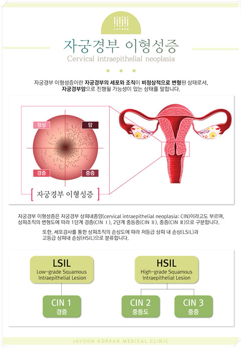 자궁경부암 hpv 병과 검사 Q&A (여자라면 꼭 읽어봐야함) | 인스티즈