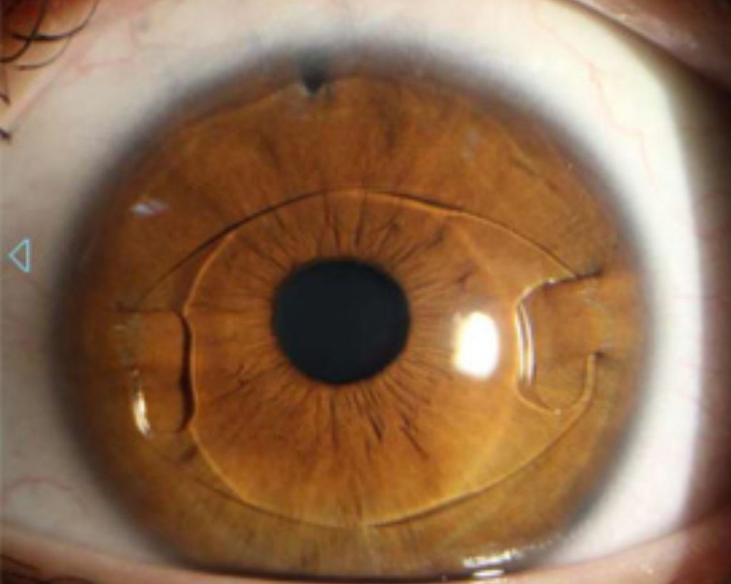 렌즈 삽입 시력 교정 | 인스티즈