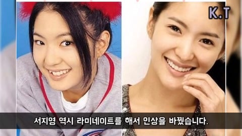 연예인들 라미네이트 전후 | 인스티즈