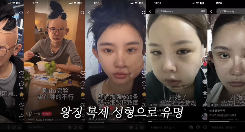 중녀 미감 만들어준다는 왕징 성형외과 다녀온 유튜버.jpg | 인스티즈