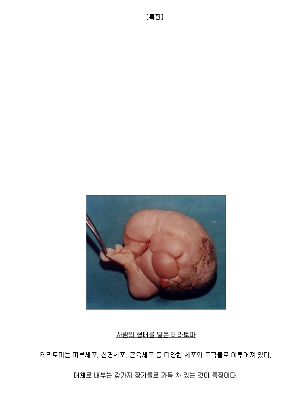 사람을 닮은 기괴한 암덩어리 테라토마 *혐오주의 | 인스티즈