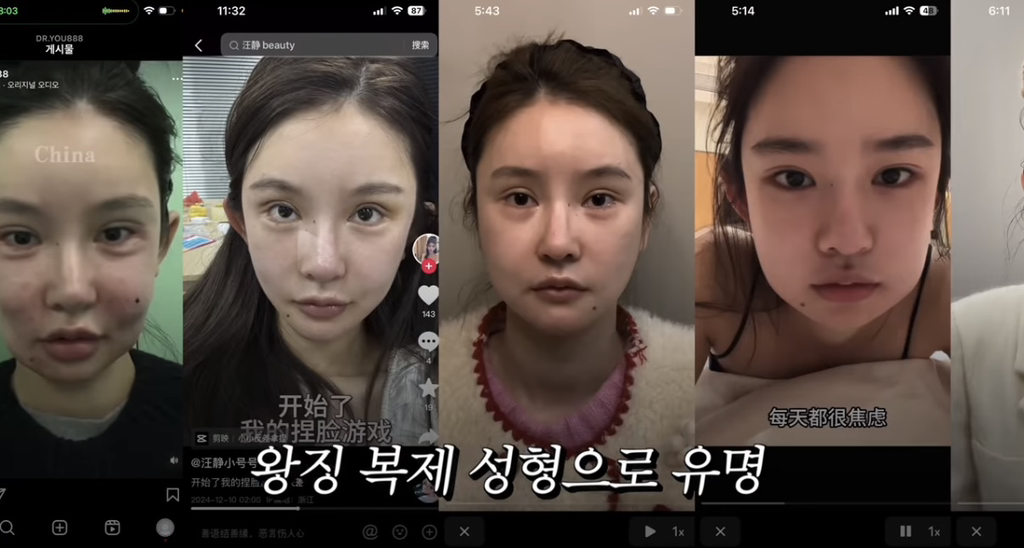 중녀 미감 만들어준다는 왕징 성형외과 다녀온 유튜버.jpg | 인스티즈