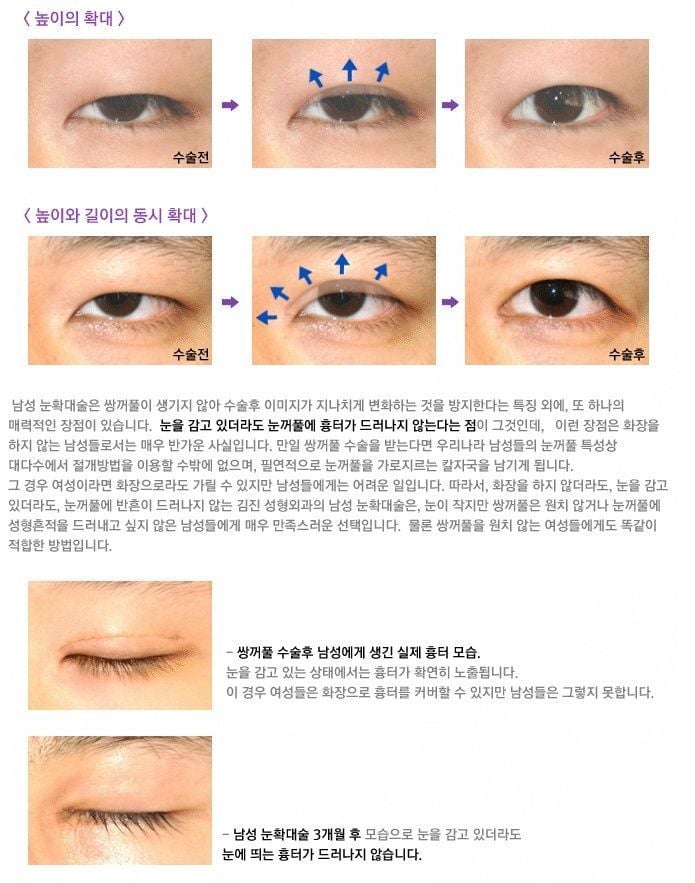 요즘 남자들이 많이 한다는 눈 성형 | 인스티즈