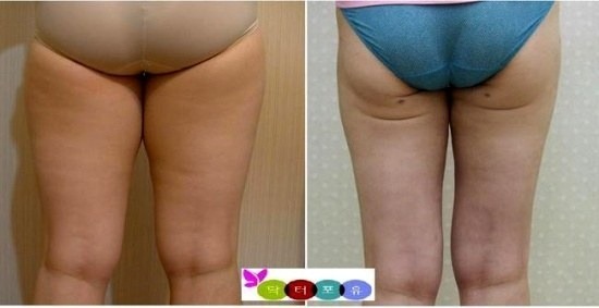 여자 아이돌 허벅지에 남겨진 의문의 흉터들 | 인스티즈