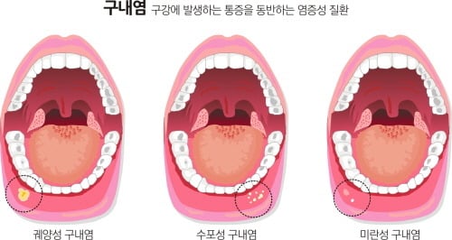 군대가면 많이 걸리는 병들 .jpg | 인스티즈