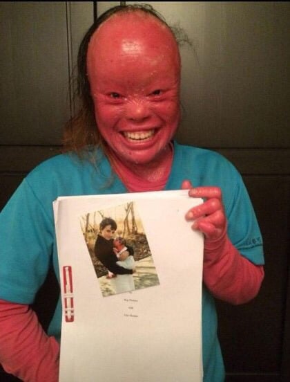 '할리퀸 어린선'을 가지고 태어난 아기..(사진주의!정말 놀랄수있어요) | 인스티즈