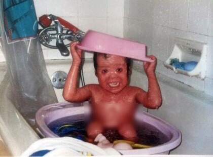 '할리퀸 어린선'을 가지고 태어난 아기..(사진주의!정말 놀랄수있어요) | 인스티즈