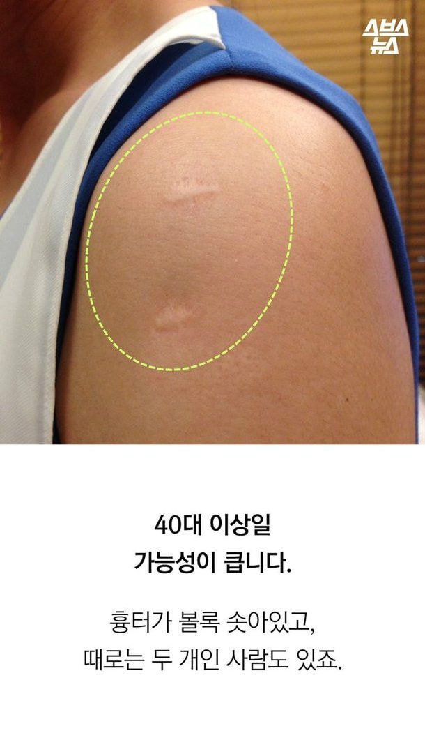 진짜 애기들한테서만 볼 수 있는 불주사자국...jpg | 인스티즈