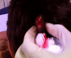 [난감주의] 피지낭종 짜는거.gif (무조건 주의) | 인스티즈