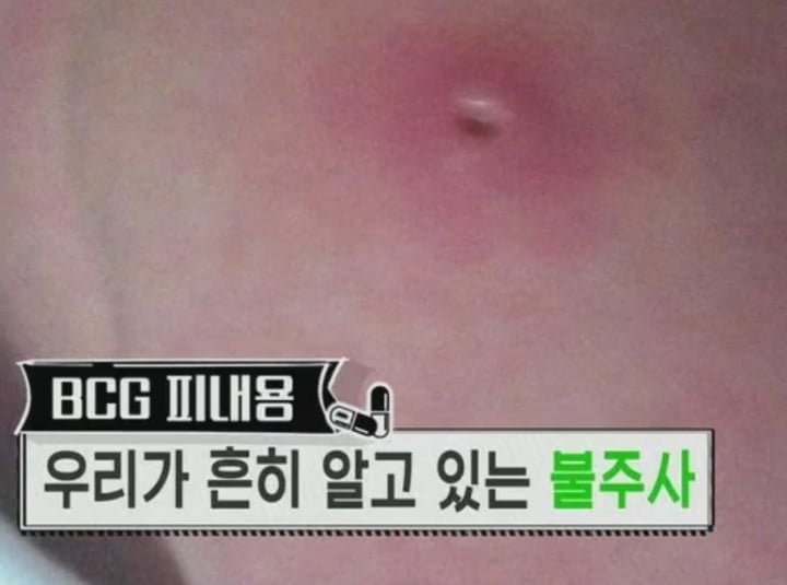 진짜 애기들한테서만 볼 수 있는 불주사자국...jpg | 인스티즈