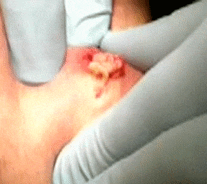 [난감주의] 피지낭종 짜는거.gif (무조건 주의) | 인스티즈