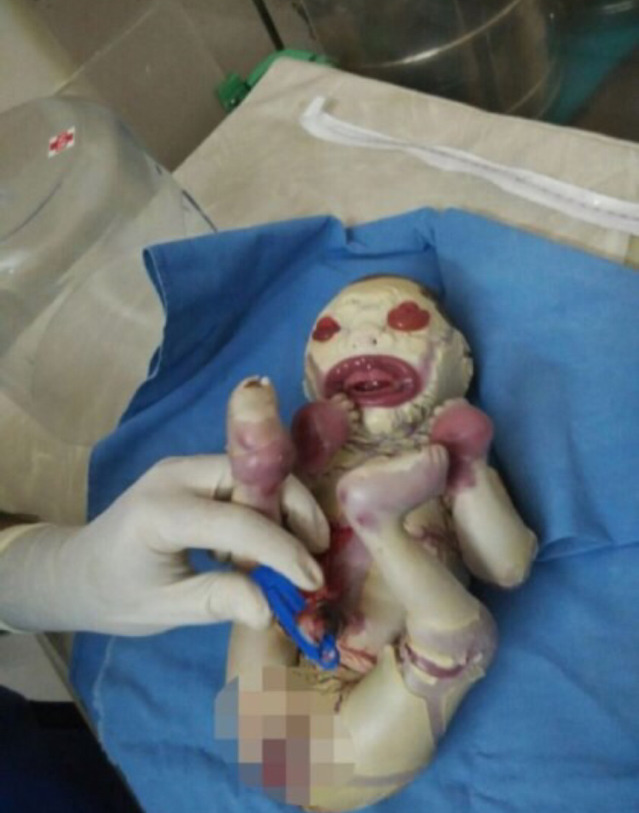 '할리퀸 어린선'을 가지고 태어난 아기..(사진주의!정말 놀랄수있어요) | 인스티즈