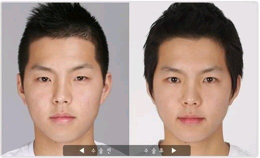 남자 앞트임 수술 전후 | 인스티즈