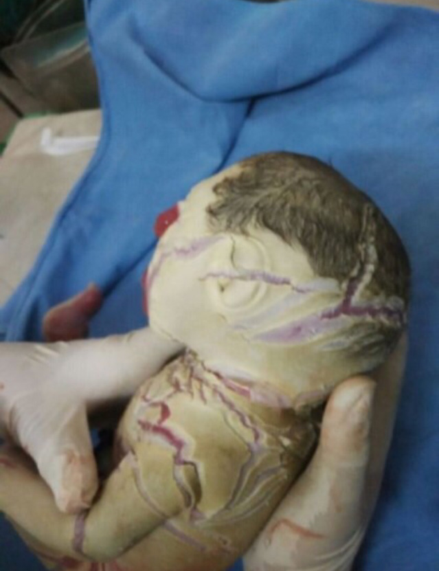 '할리퀸 어린선'을 가지고 태어난 아기..(사진주의!정말 놀랄수있어요) | 인스티즈