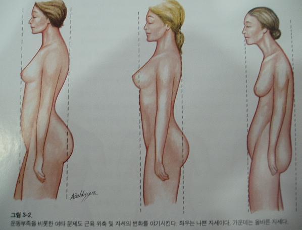 말랐는데 배만 불뚝?! 척추전만증 의심해봐야 | 인스티즈