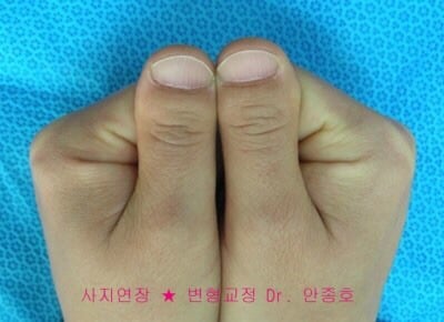 단지증 (우렁손톱) 을 아시나요? | 인스티즈