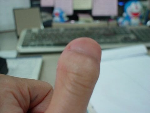 단지증 (우렁손톱) 을 아시나요? | 인스티즈