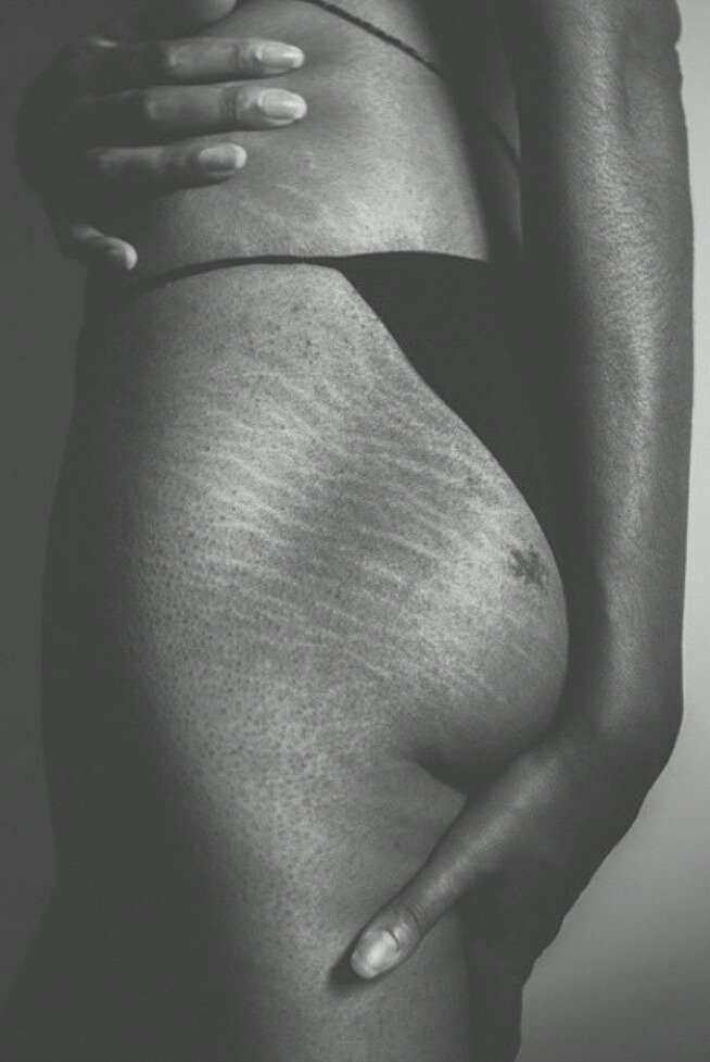 피부 튼살로 고민이 많은 여시들이 봐줬으면 하는 글 | 인스티즈