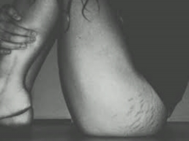 피부 튼살로 고민이 많은 여시들이 봐줬으면 하는 글 | 인스티즈