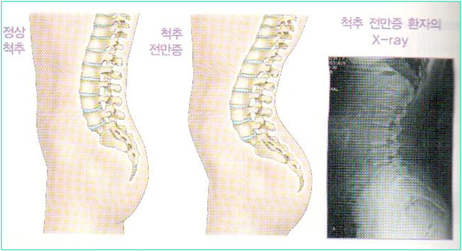 말랐는데 배만 불뚝?! 척추전만증 의심해봐야 | 인스티즈