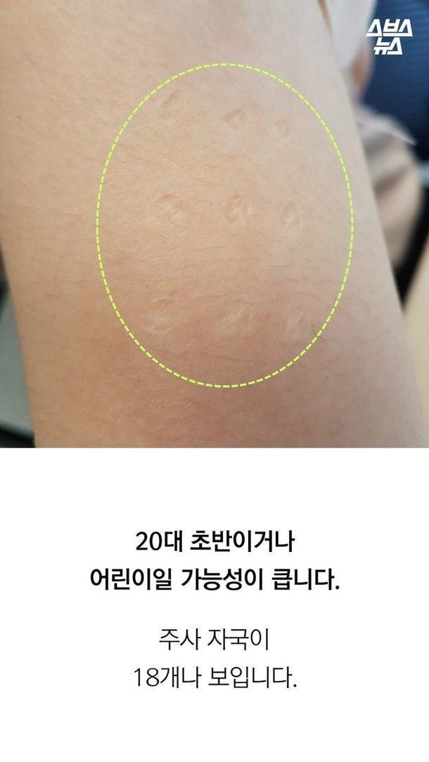 진짜 애기들한테서만 볼 수 있는 불주사자국...jpg | 인스티즈