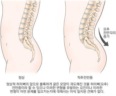 말랐는데 배만 불뚝?! 척추전만증 의심해봐야 | 인스티즈