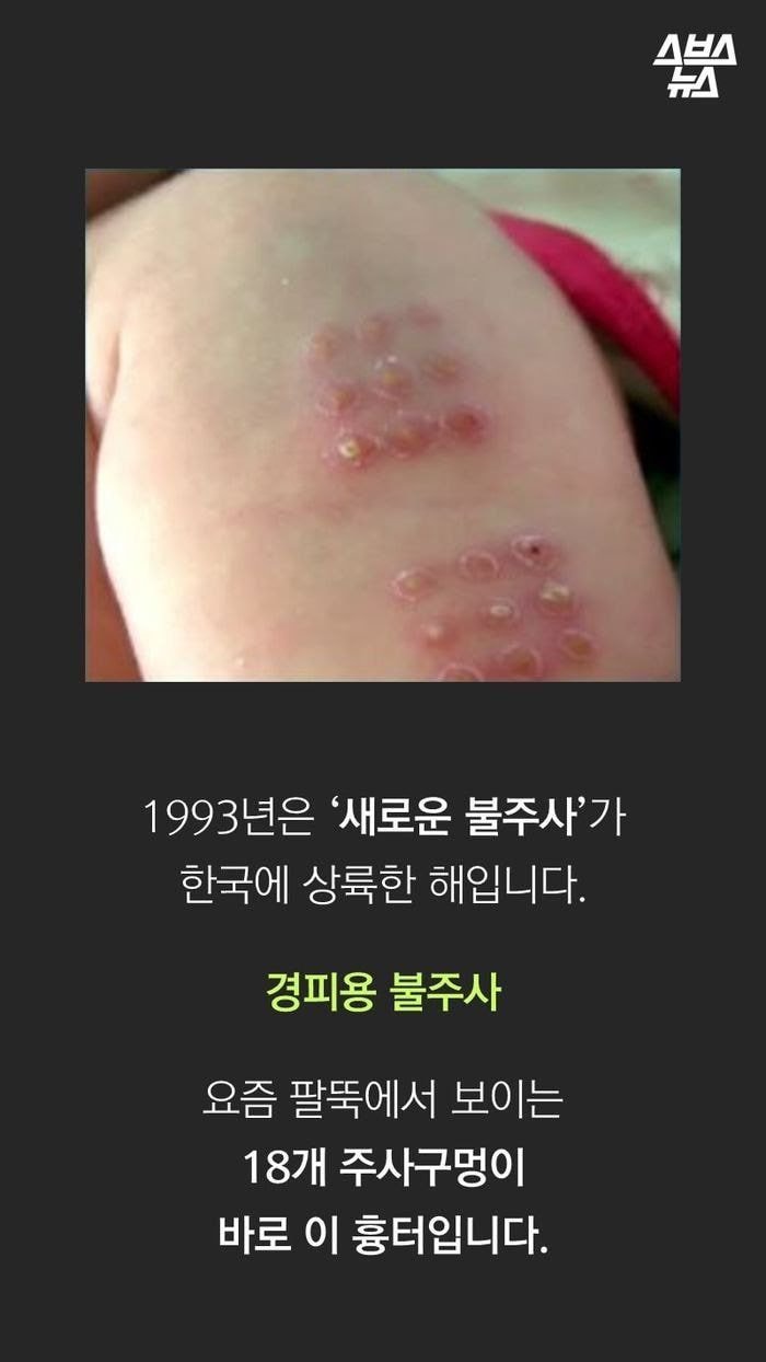 진짜 애기들한테서만 볼 수 있는 불주사자국...jpg | 인스티즈
