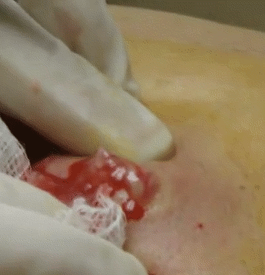 [난감주의] 피지낭종 짜는거.gif (무조건 주의) | 인스티즈