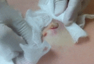 [난감주의] 피지낭종 짜는거.gif (무조건 주의) | 인스티즈