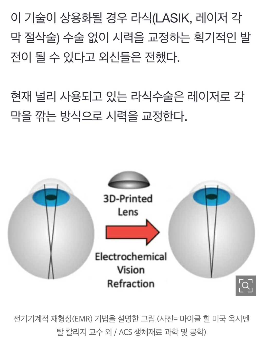 "라식수술 필요 없다"…1분 만에 시력 교정하는 기술 나왔다 | 인스티즈
