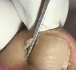 쾌감 오지는 내성발톱 제거 움짤ㄷㄷㄷㄷㄷㄷ. gif (혐오주의) | 인스티즈