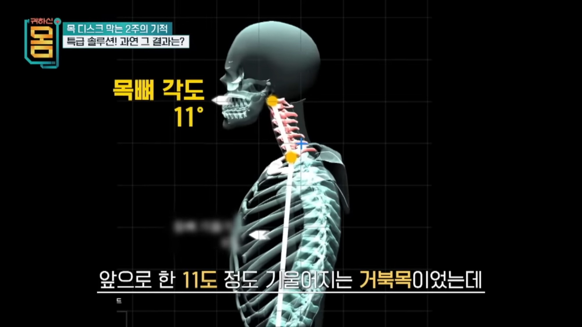 2주만에 효과 대박인 거북목•일자목 마사지&운동 | 인스티즈