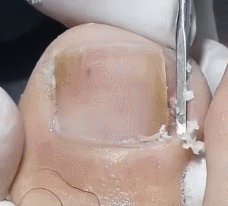 쾌감 오지는 내성발톱 제거 움짤ㄷㄷㄷㄷㄷㄷ. gif (혐오주의) | 인스티즈