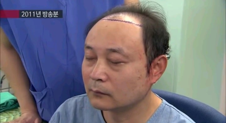 실제 모발이식 수술 장면.jpg (사진주의) | 인스티즈