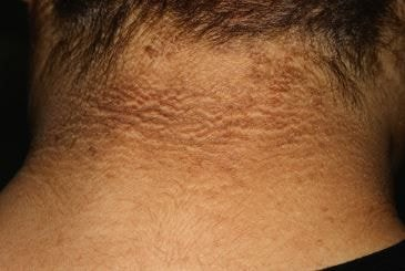 99%가 땟자국이라고 생각했던 목 뒤 '검은 튼 살'의 소름끼치는 정체 | 인스티즈