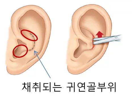 기기괴괴 그 자체인 요즘 유행한다는 코 수술 방법(혐) | 인스티즈