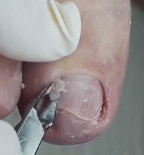 쾌감 오지는 내성발톱 제거 움짤ㄷㄷㄷㄷㄷㄷ. gif (혐오주의) | 인스티즈