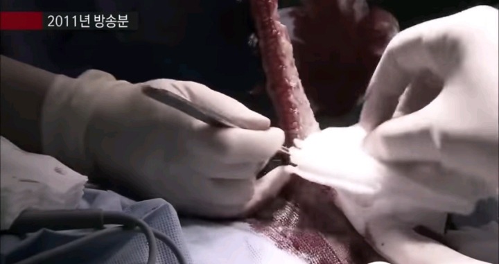 실제 모발이식 수술 장면.jpg (사진주의) | 인스티즈