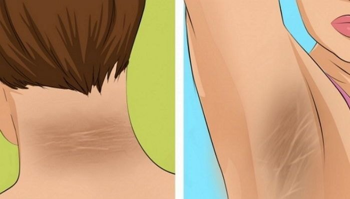 99%가 땟자국이라고 생각했던 목 뒤 '검은 튼 살'의 소름끼치는 정체 | 인스티즈