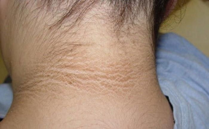 99%가 땟자국이라고 생각했던 목 뒤 '검은 튼 살'의 소름끼치는 정체 | 인스티즈