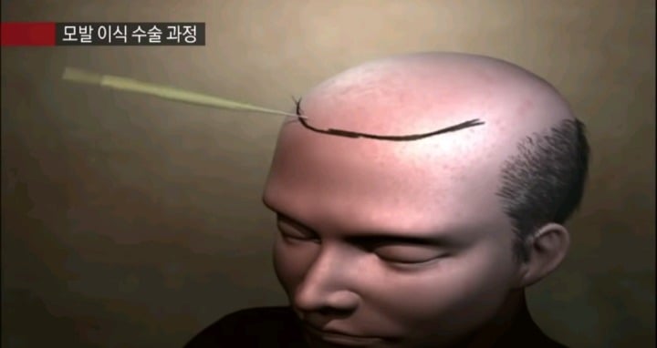 실제 모발이식 수술 장면.jpg (사진주의) | 인스티즈